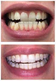 3 WAYS TO TAKE CARE OF YOUR DENTAL IMPLANT