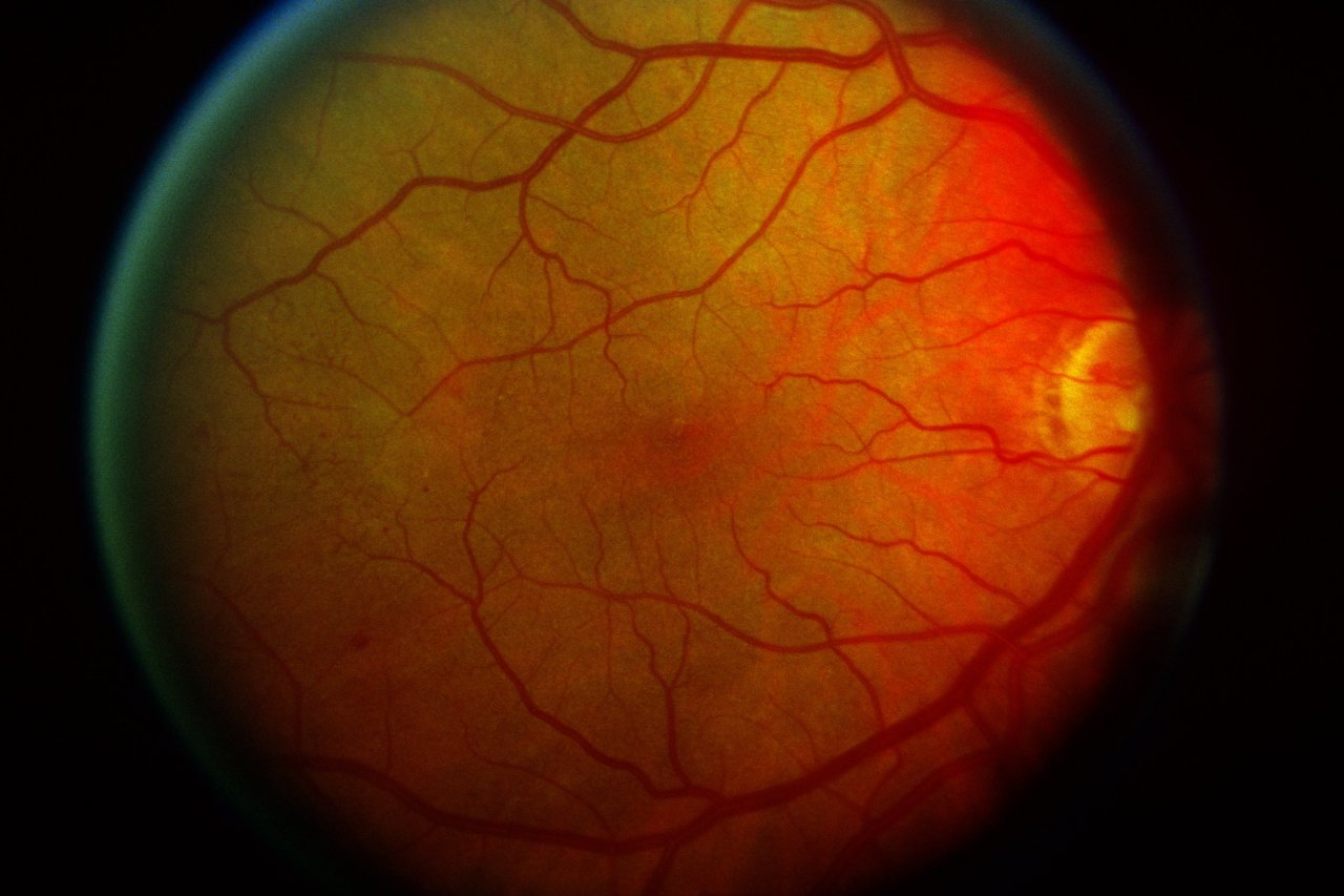 Diabetic Retinopathy Market Growth Accelerated By Rising Prevalence Of Diabetes
