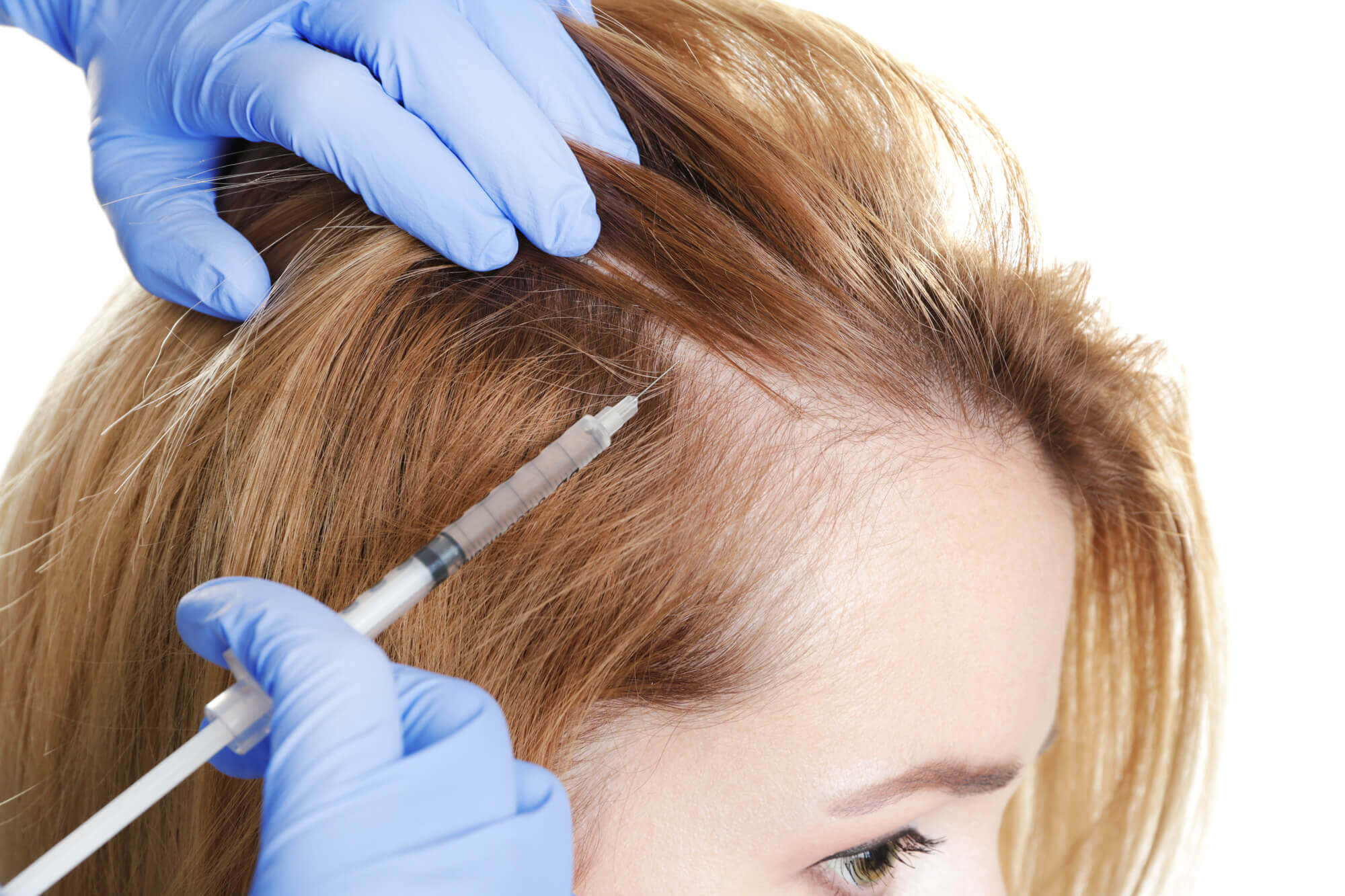 The Global Alopecia Treatment Market Growth Accelerated By New Product Launches