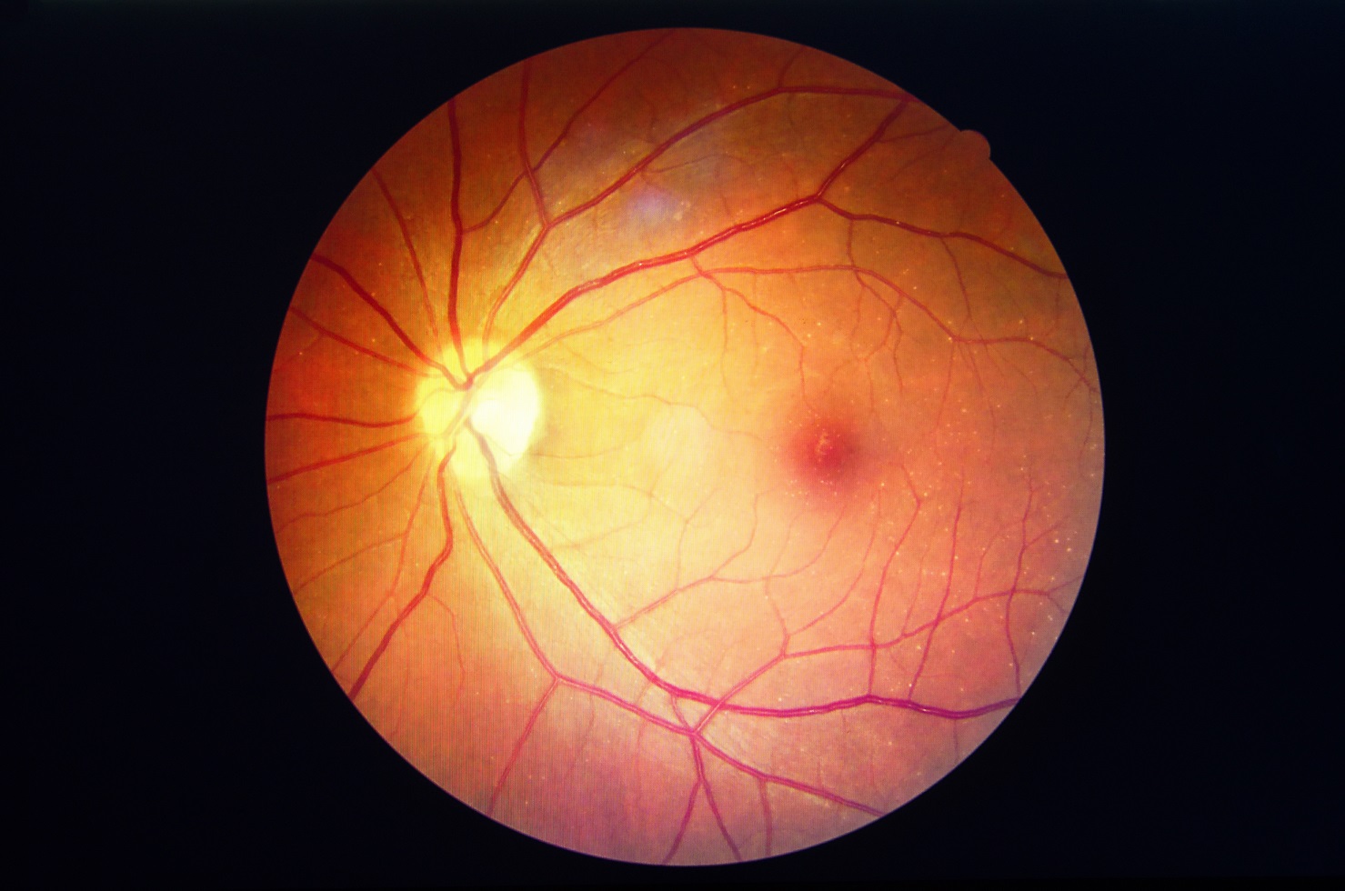 Diabetic Retinopathy: A Silent Threat To Vision