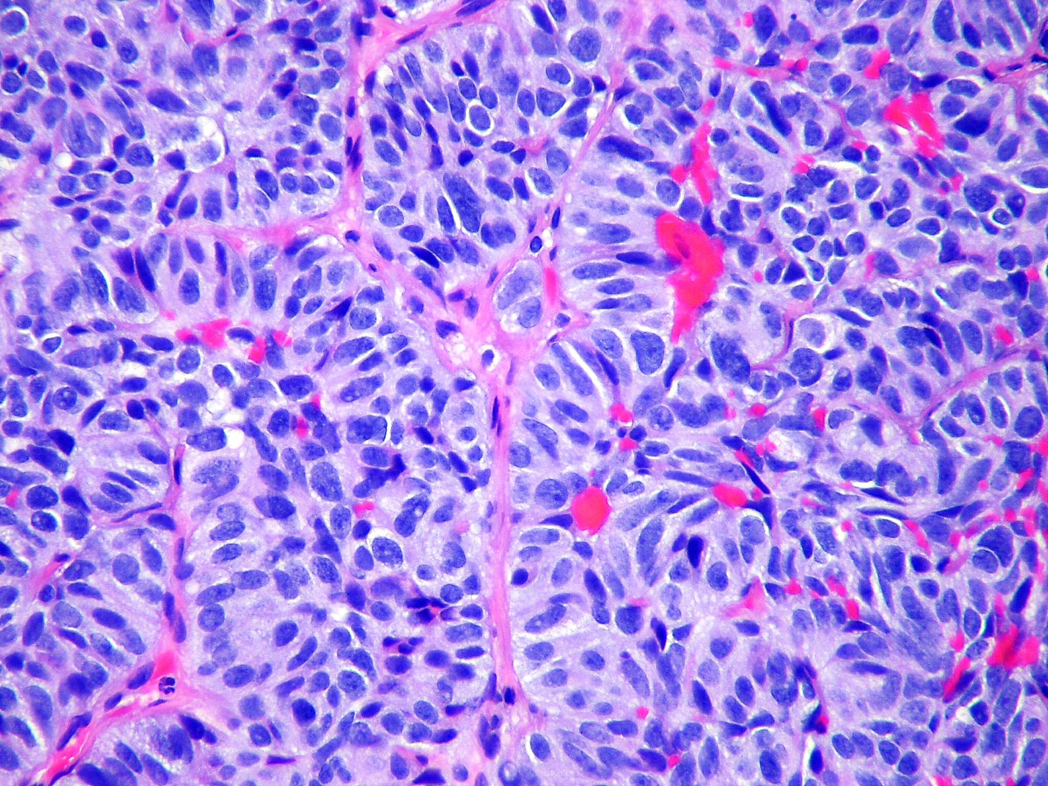 Anatomic Pathology Market Growth Accelerated By Increasing Prevalence Of Cancer