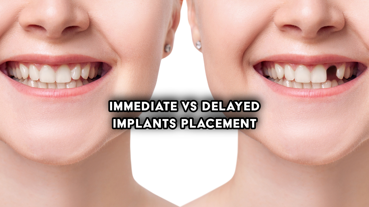 Unveiling the World of Dental Implants: A Comprehensive Guide  