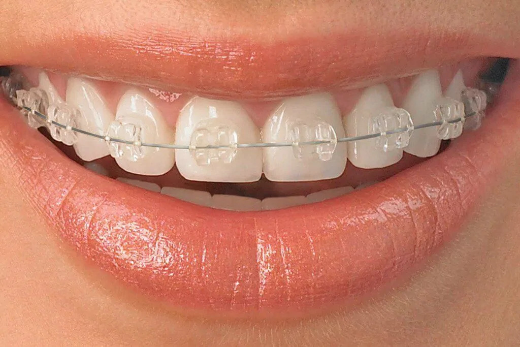 Braces Cost in Gurgaon