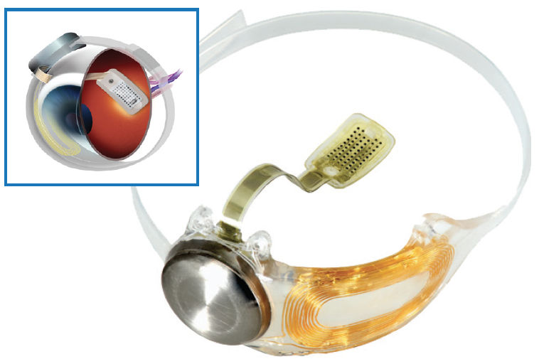 Retinal Implants Market Size, Status, Growth | Industry Analysis Report 2022-2030