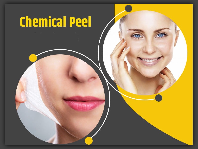Chemical Peel Market 2023 Size, Growth Factors & Forecast Report to 2032