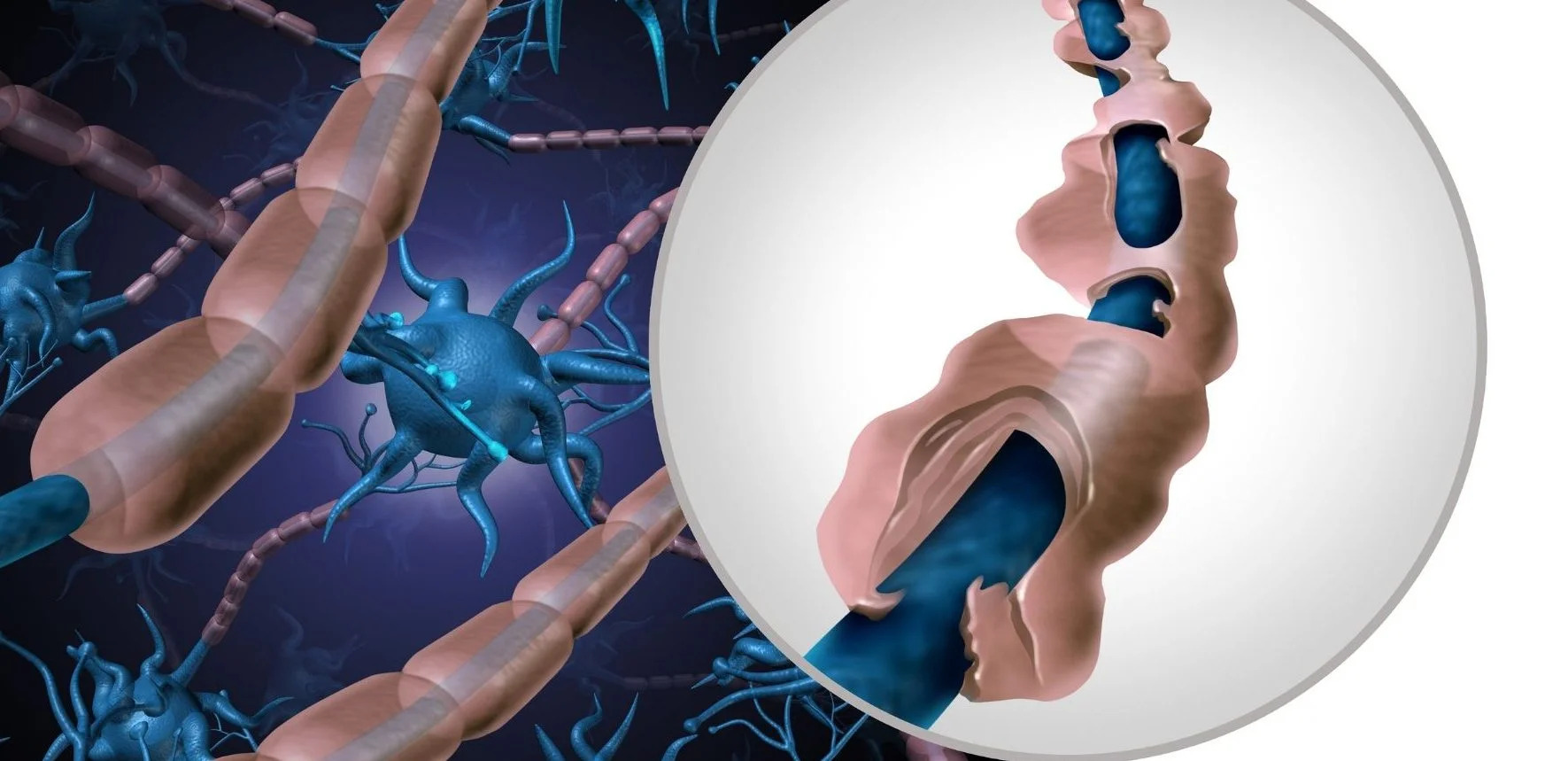 Global Multiple Sclerosis Market Size, Share, Growth & Forecast 2031