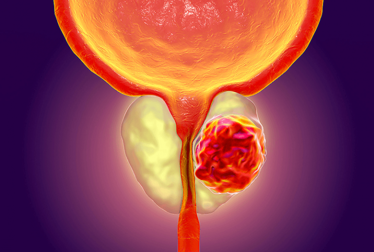 Global Prostate Cancer Biopsy Market Size, Share, & Growth Report 2031