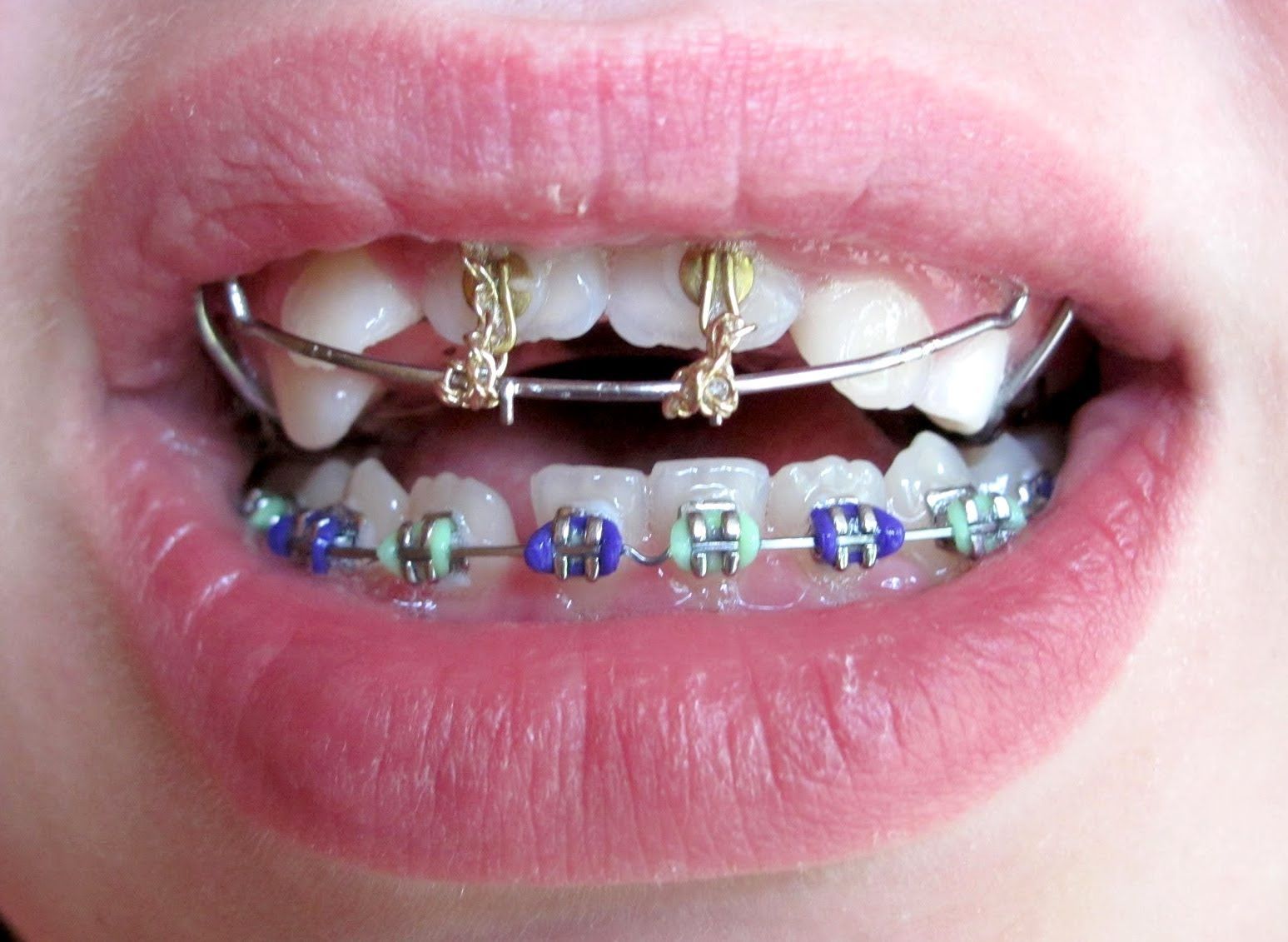 The Easiest Way to Choose Braces Color Wheel