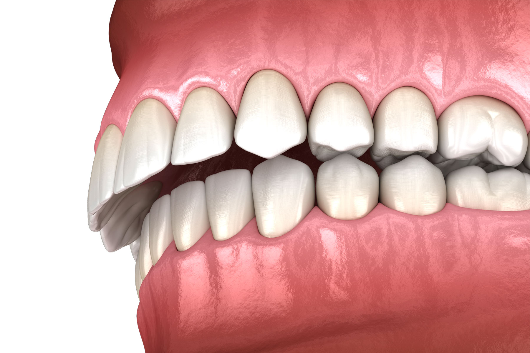 What is an Overbite and How is it Corrected?
