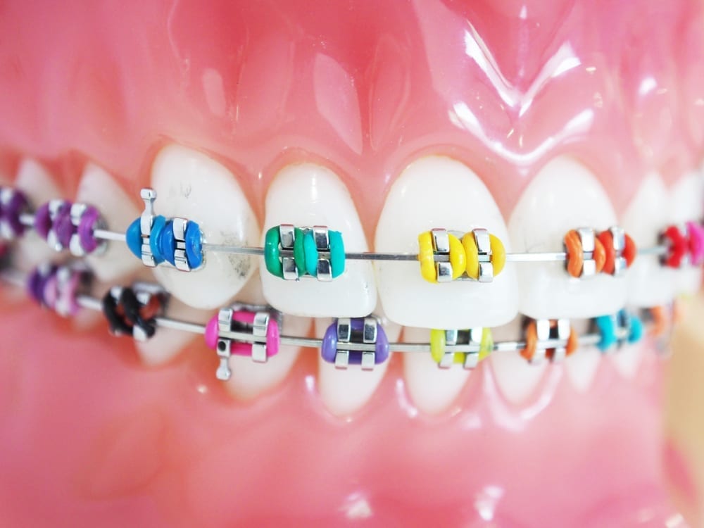 What Are The Best Different Color Braces Options Available For Girls And Boys?