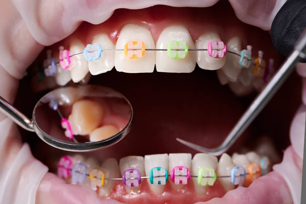 What Does Your Braces Rubber Band Color Say About You?