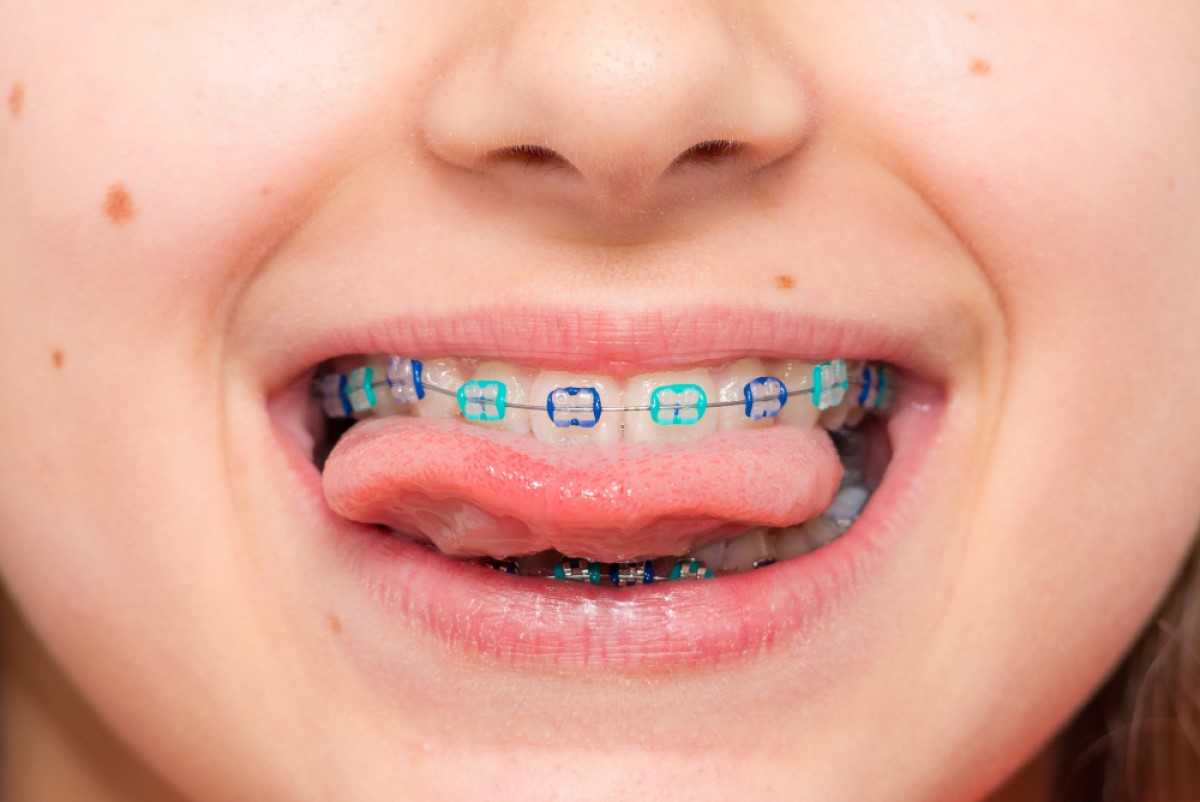 How Much Do Braces Cost Per Month Without Insurance