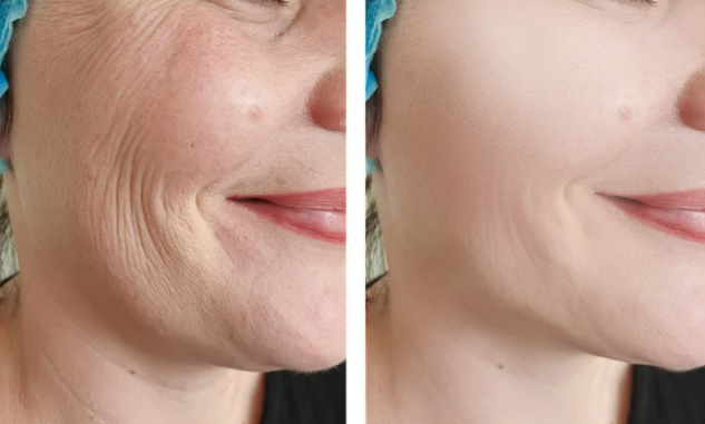 Microneedling for Fine Lines and Wrinkles:  Real Results and Case Studies