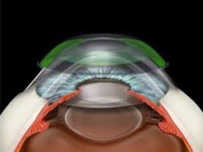 Exploring the Visionary Solution: Orthokeratology