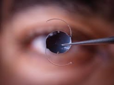 The Global Intraocular Lens Market Is Driven By Growing Cataract Surgery Rates