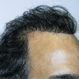 The Pros and Cons of Hair Transplantation