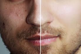 What Is Coolsculpting Treatment And How It Can Make You Slim?