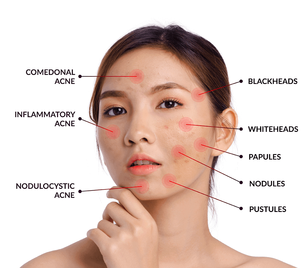 Pimples: Understanding, Prevention, and Effective Treatment Options