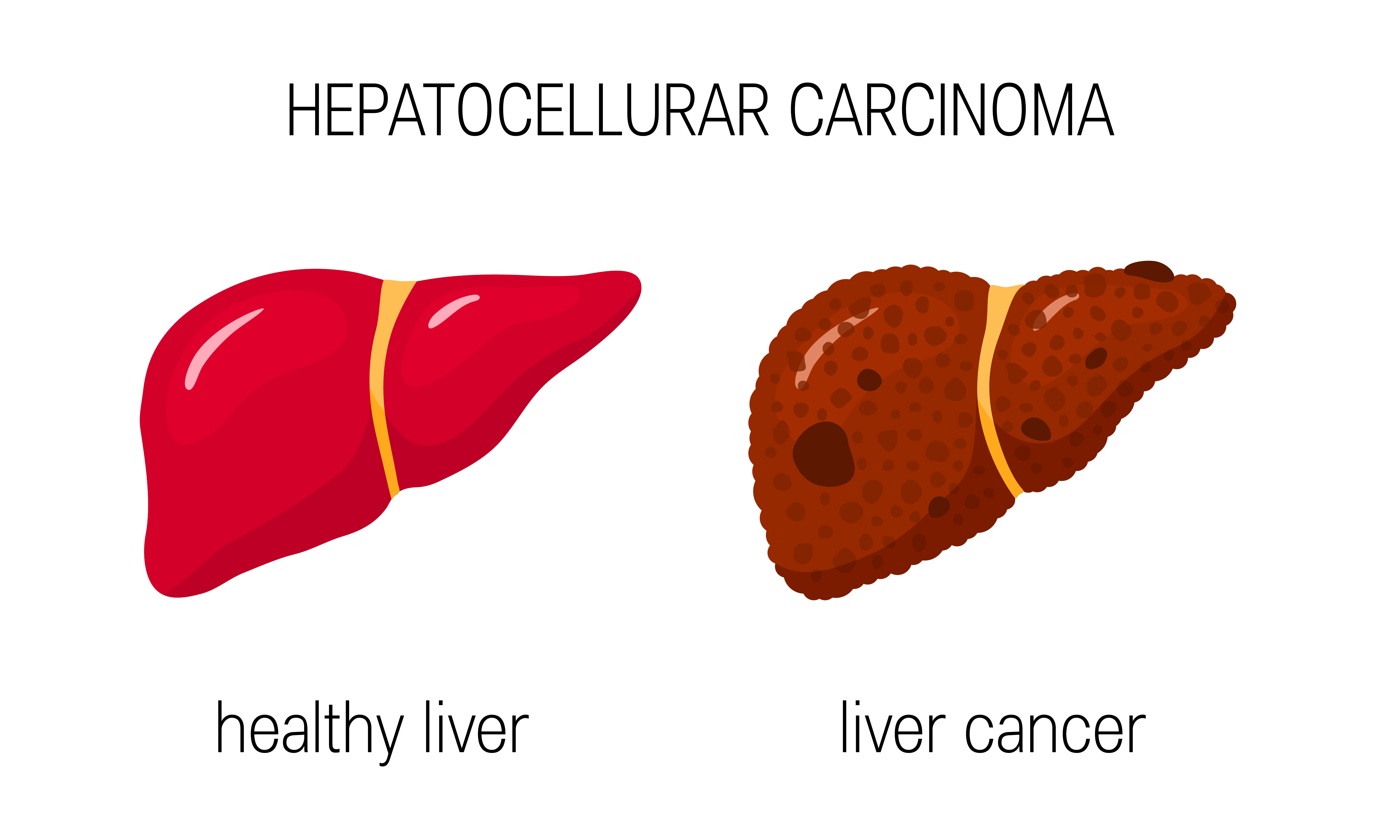 Decoding Liver Cancer: Understanding Types, Foundations, and Clinical Trials