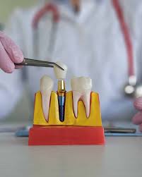 Restore Your Smile with Modern Implants