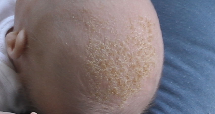 Safe cradle cap products for infants