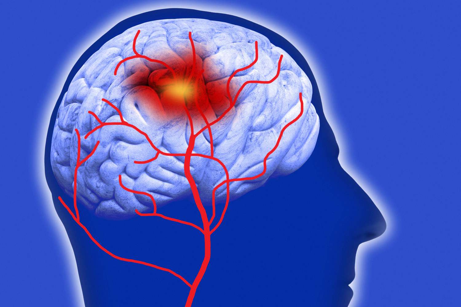 Traumatic Brain Injury Therapeutics Market Growth Accelerated by Increasing Incidences of Head Injuries