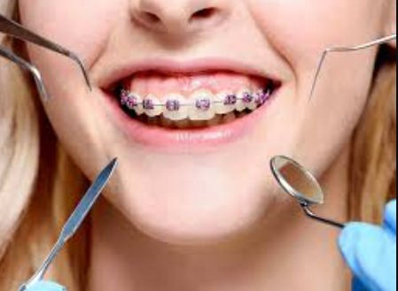 PAINLESS ORTHODONTICS: INNOVATIONS IN BRACES TREATMENT IN THANE