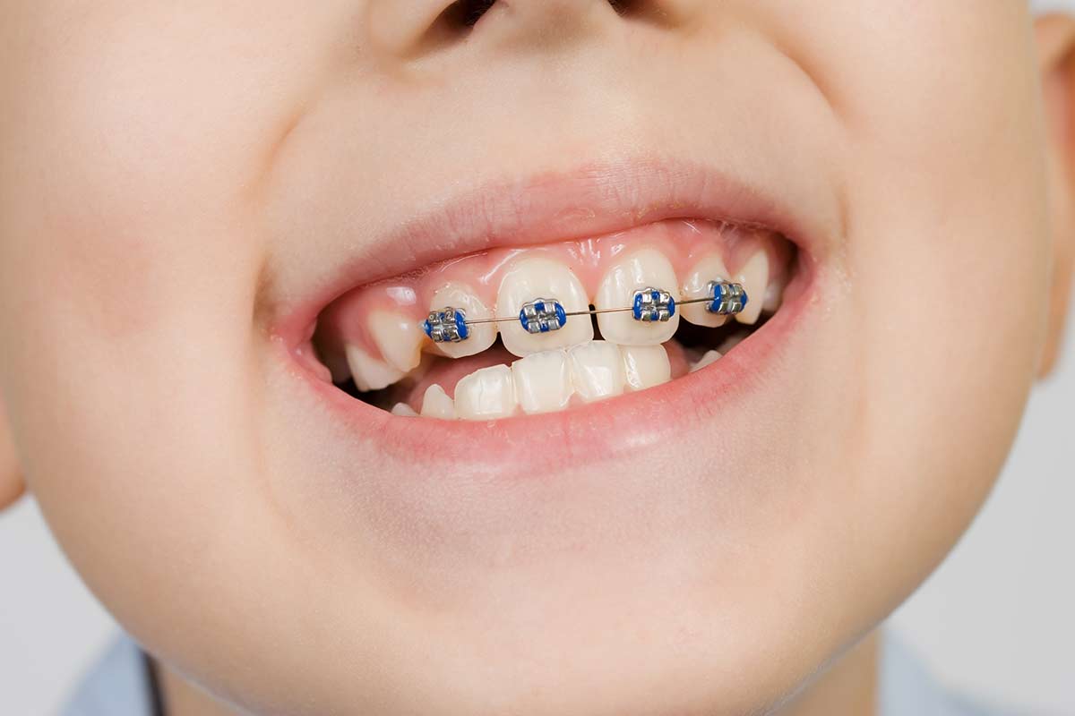 WHEN SHOULD KIDS IN THANE GET THEIR FIRST ORTHODONTIC CHECK-UP?