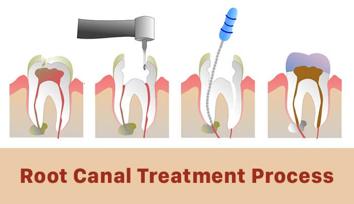 PREPARING FOR YOUR ROOT CANAL: TIPS FROM THANE’S MOST TRUSTED DENTISTS