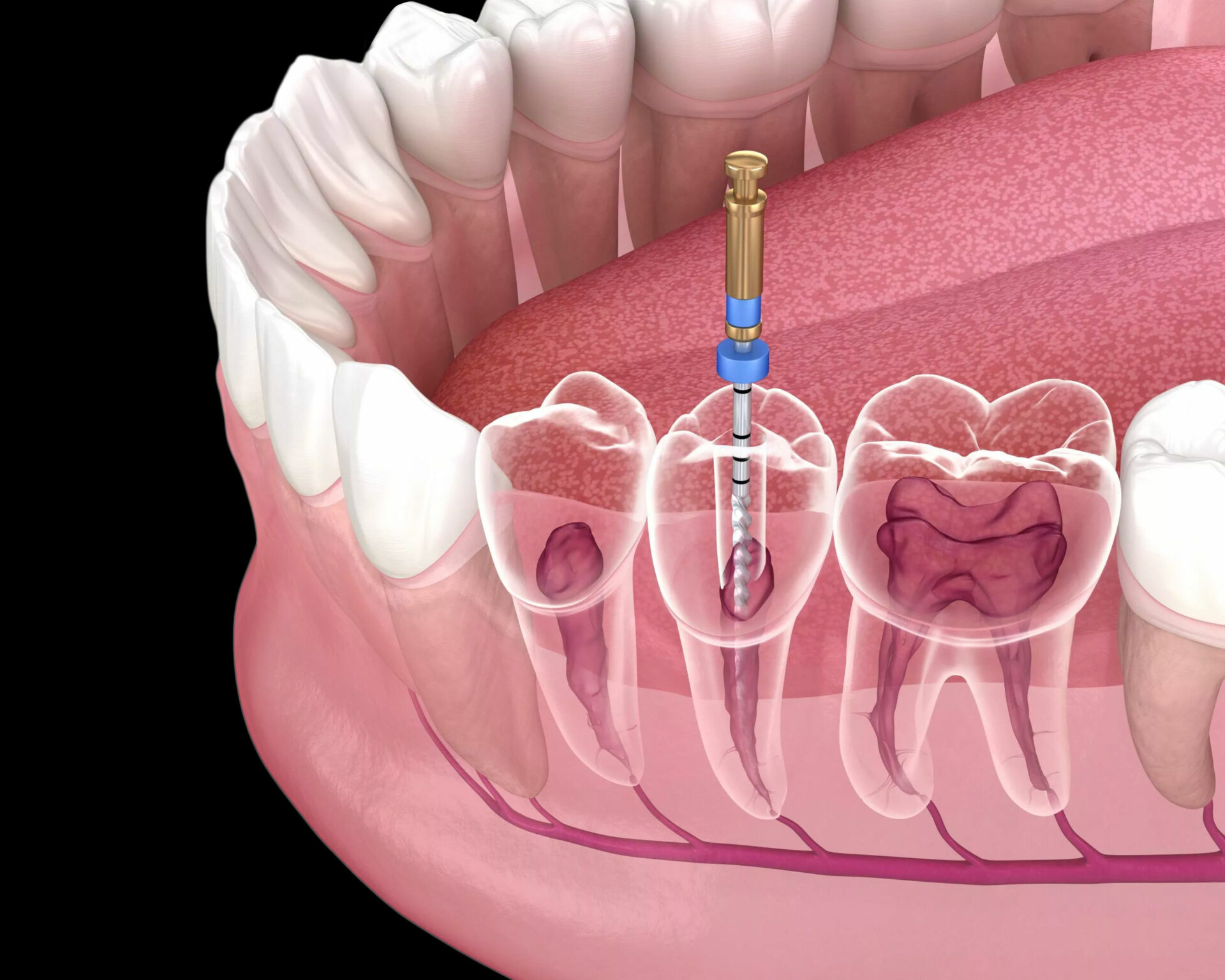 ROOT CANAL TREATMENT FOR CHILDREN: WHEN IS IT NECESSARY?