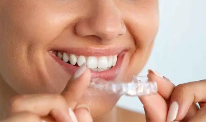 MAINTAINING ORAL HEALTH DURING INVISALIGN TREATMENT: TIPS FROM THANE EXPERTS - The Smile Wellness