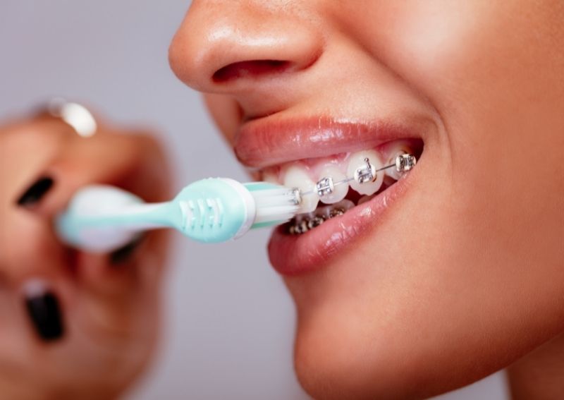 LIFE WITH BRACES: WHAT TO EXPECT IN THANE