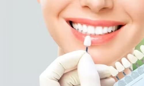Maintaining and Caring for Dental Veneers in Thane
