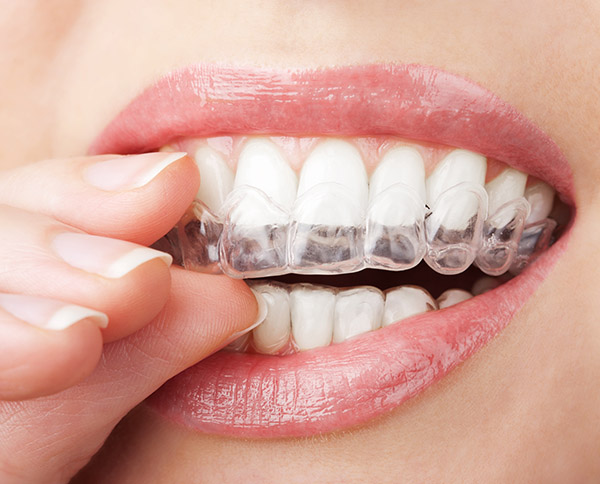 Smile Makeover: Transforming Lives with Invisalign at Our Thane Treatment Center