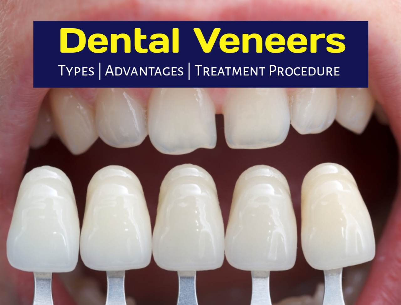 DISCUSS FACTORS INFLUENCING THE COST AND HOW TO BUDGET FOR VENEER TREATMENTS