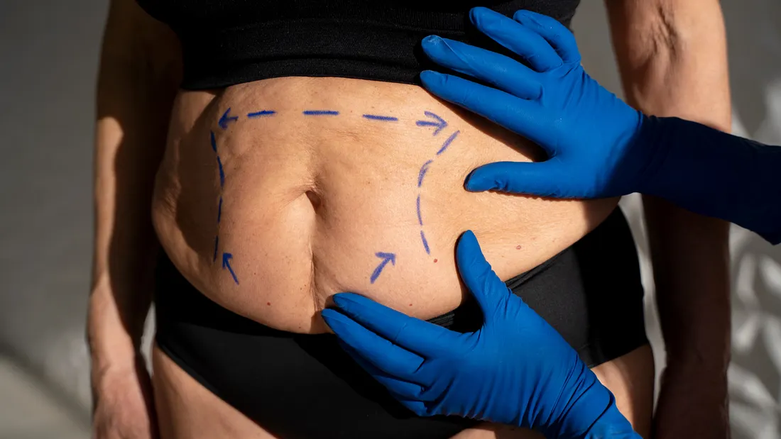 Discover Everything About Liposculpture