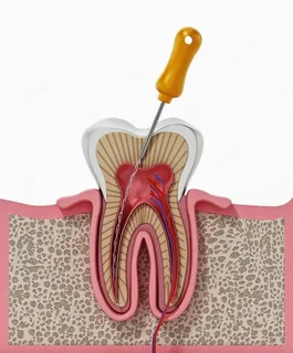Single Sitting Root Canal Treatment in Kolhapur: A Faster, Comfortable Solution for Tooth Pain