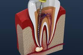 Signs You Need Root Canal Treatment: Symptoms and Diagnosis