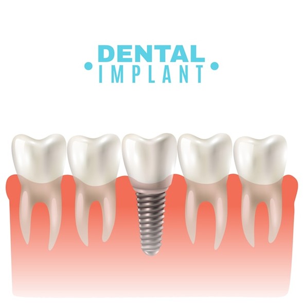 Why Dental Implants Are the Best Solution for Missing Teeth