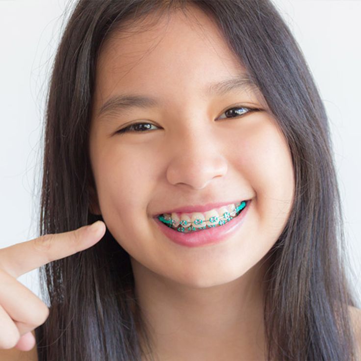 How Braces Help Kids Achieve a Healthy, Beautiful Smile