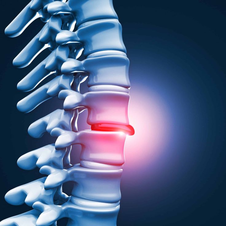 How Neurotherapy Helps in Managing Degenerative Disc Disease