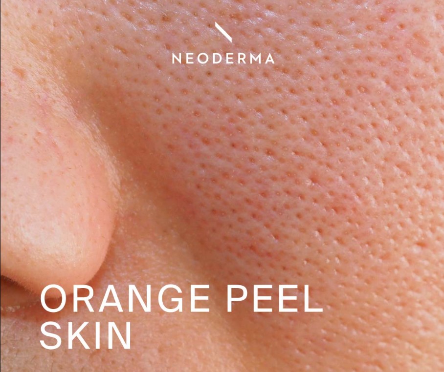 Understanding Orange Peel Skin: What It Means and How to Take Care of It