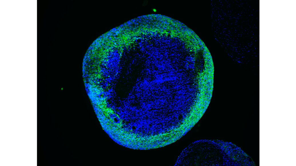 Emerging Trends and Innovations in the Global Leigh Syndrome Treatment Market