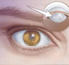 Cataract Eye Surgery in Delhi