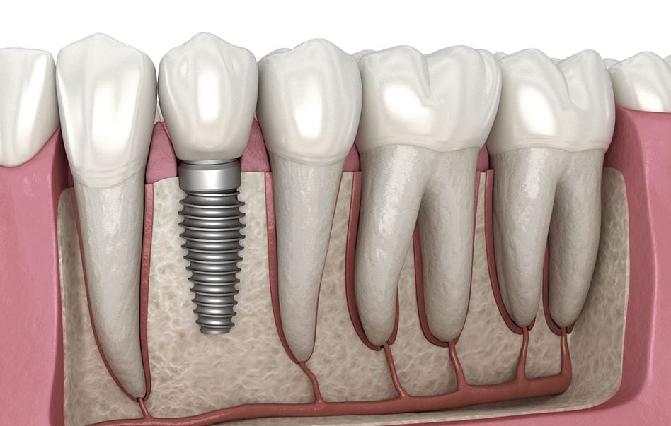 Dental Implants vs. Bridges: Understanding the Differences and Benefits