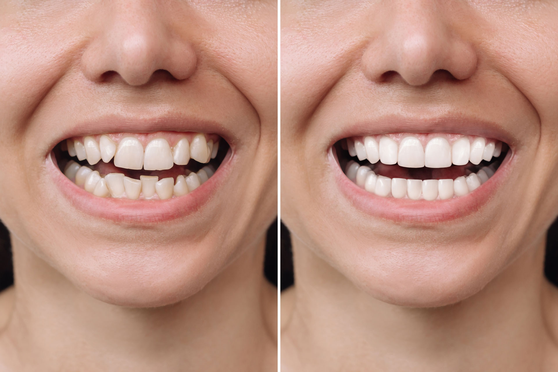 Achieve a Hollywood Smile with Dental Veneers in Dubai