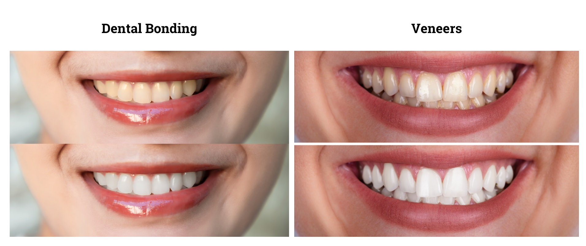  Dental Bonding vs. Veneers: Which is Right for You?