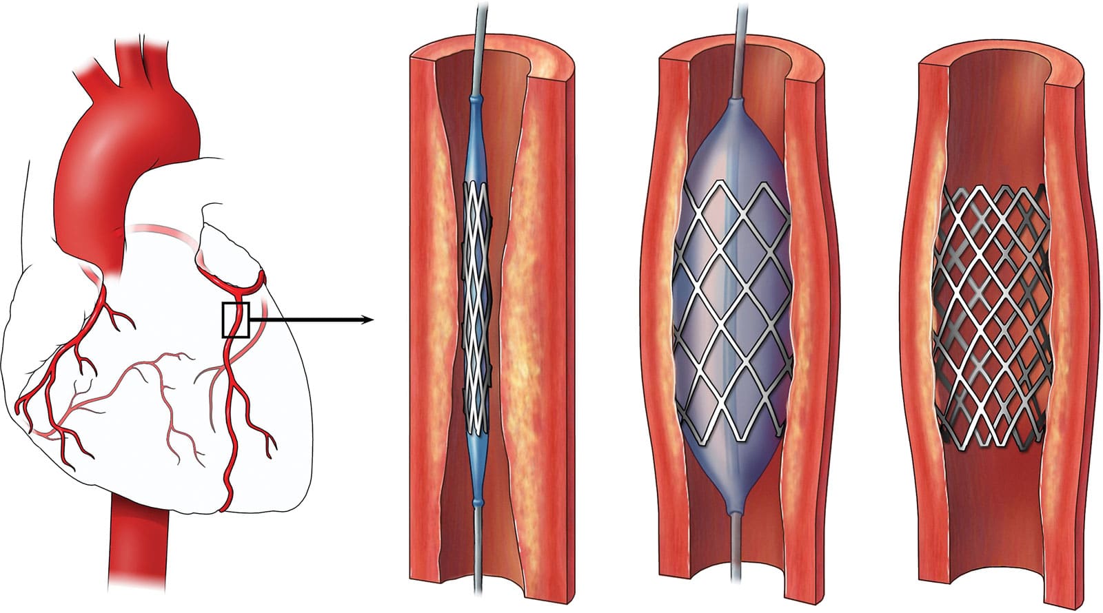 Reasons You May Need an Angioplasty