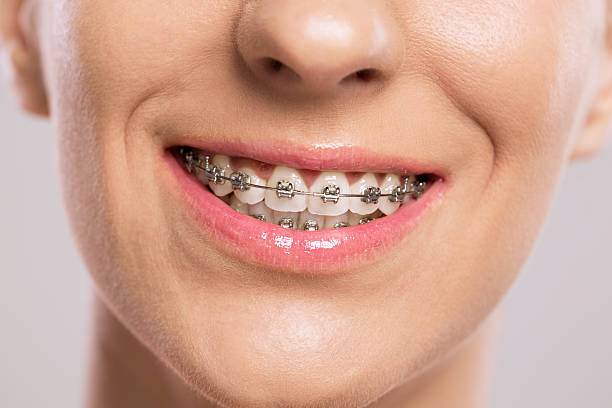 Achieving a Perfect Smile: Your Guide to Braces near Bismarck