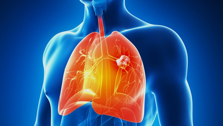 Lung Cancer Therapy Market Growth Potential and Addressing Challenges 2031